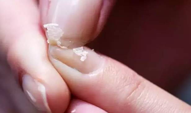 Saç dökülmesinin bir numaralı sebebi - Resim: 7